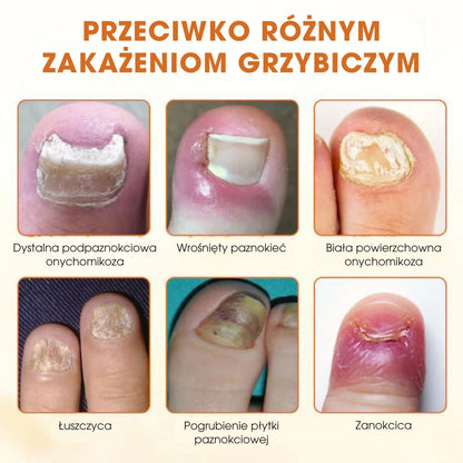 FungiBee™ - Zaawansowany spray do regeneracji paznokci - 1+1 GRATIS